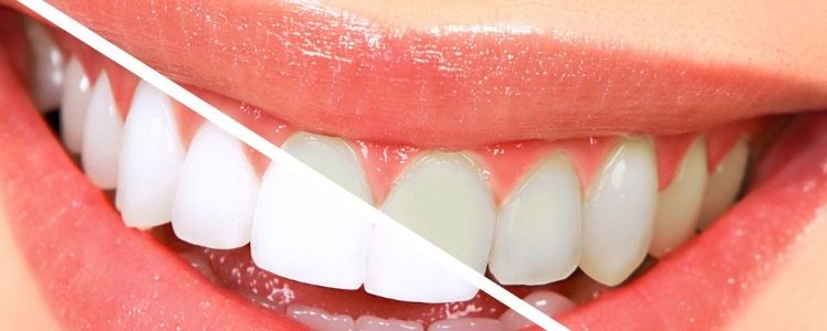 Best Teeth Whitening Toothpaste